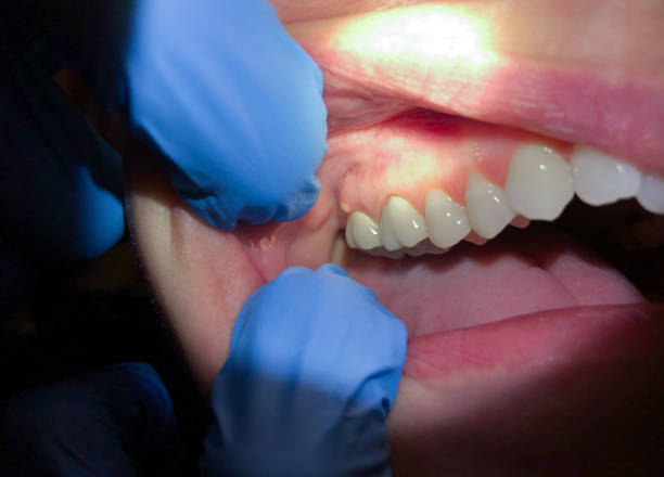 Best Knocked-Out Tooth Emergency  in Unt Vernon, MO